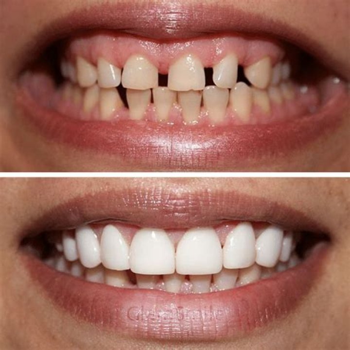 A Quick Look At Will Compton’s Dental Transformation