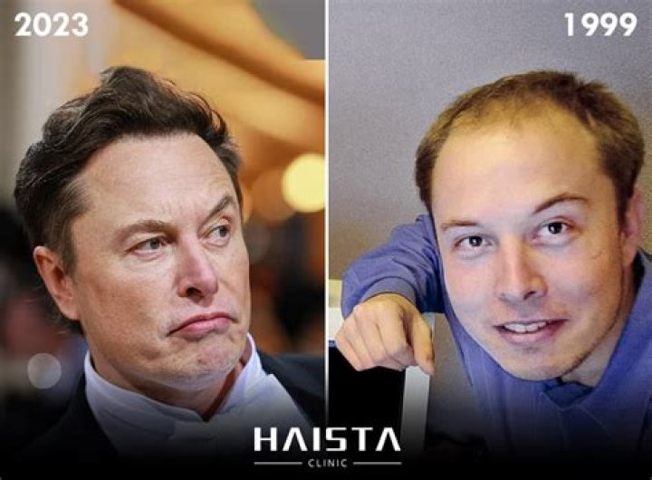 Has Elton John Had a Hair Transplant?