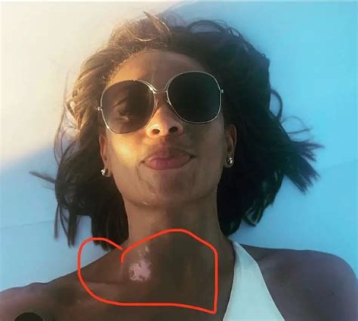 How Did Ilia Calderon Get A Neck Scar? Reddit Update On Skin Condition!